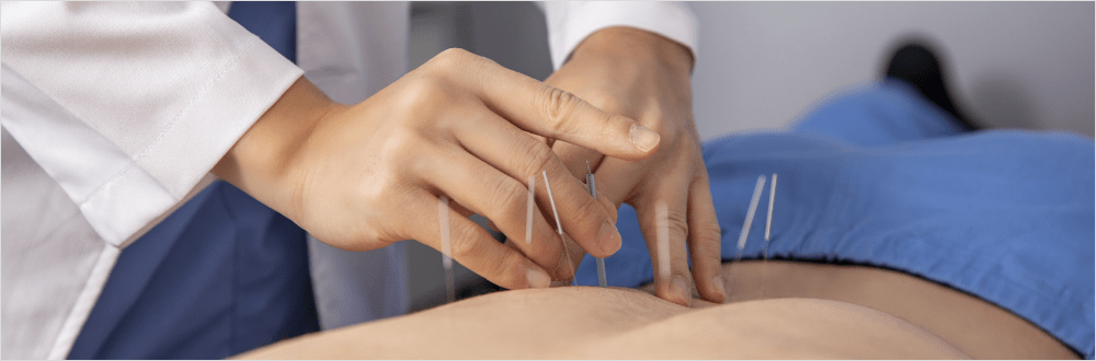 한의원 침술 치료 이미지